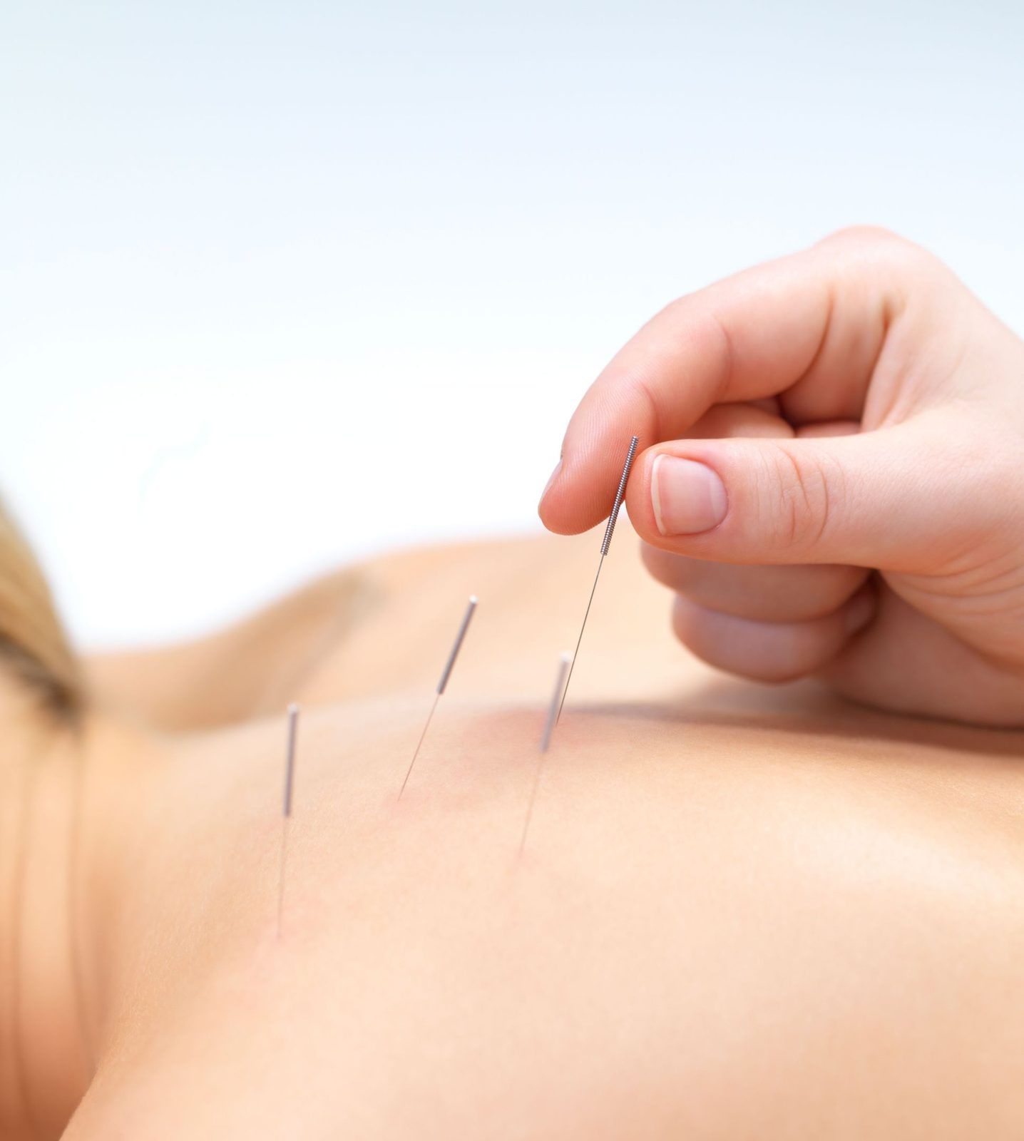 Fine acupuncture needles placed on the back