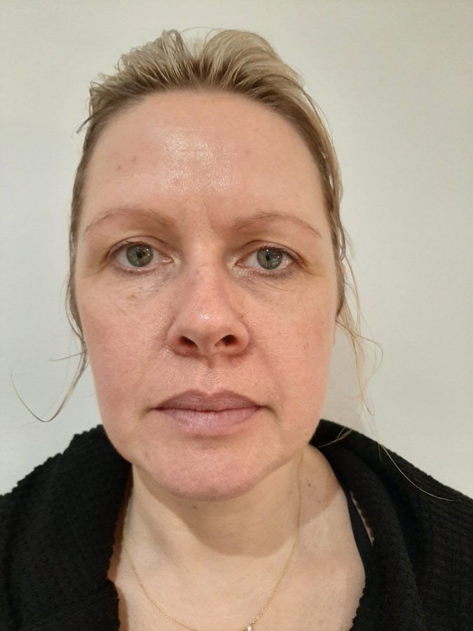 Katie, after eight treatments