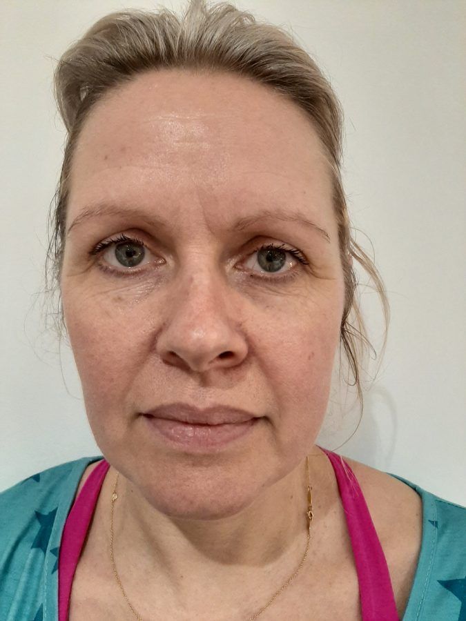 Katie, before treatment
