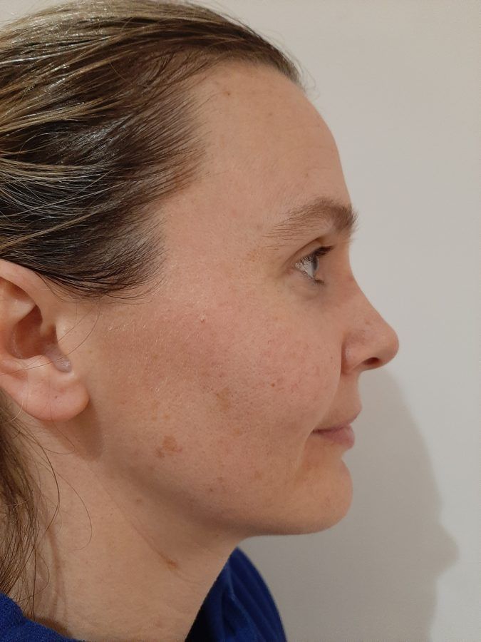 Liz, after eight treatments