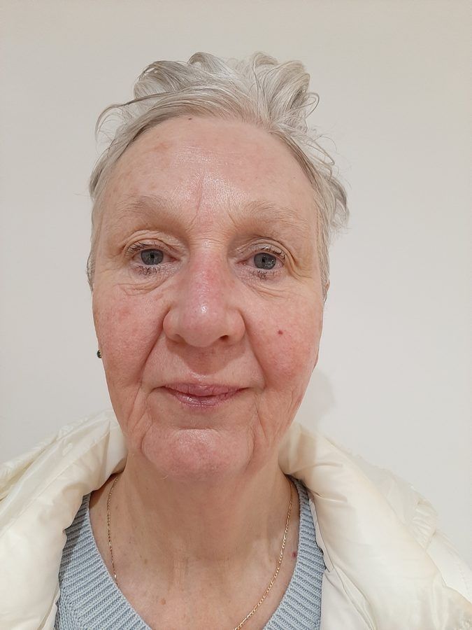 Tricia, after one treatment