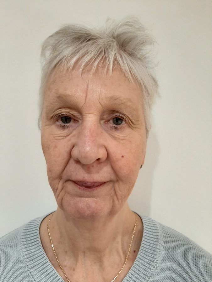 Tricia, before treatment